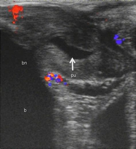 squrit men|Male squirting: Analysis of one case using color Doppler ...